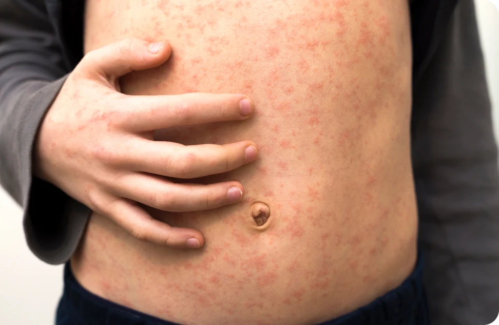 Ilustración de los síntomas de la rubéola