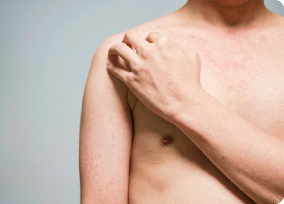 Sintomas del sarampión