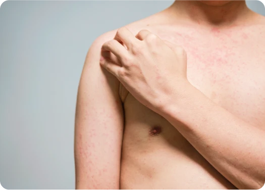 Sintomas del sarampión